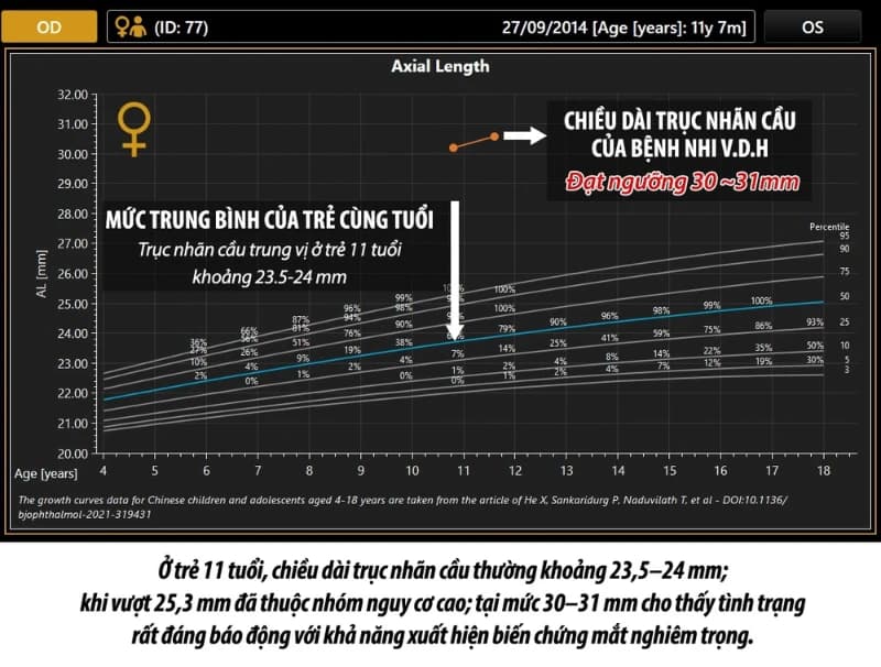 🚨 BÉ 11 TUỔI CẬN ĐẾN 14 ĐỘ – CẢNH BÁO NGUY CƠ BIẾN CHỨNG VÕNG MẠC DO CẬN THỊ TIẾN TRIỂN