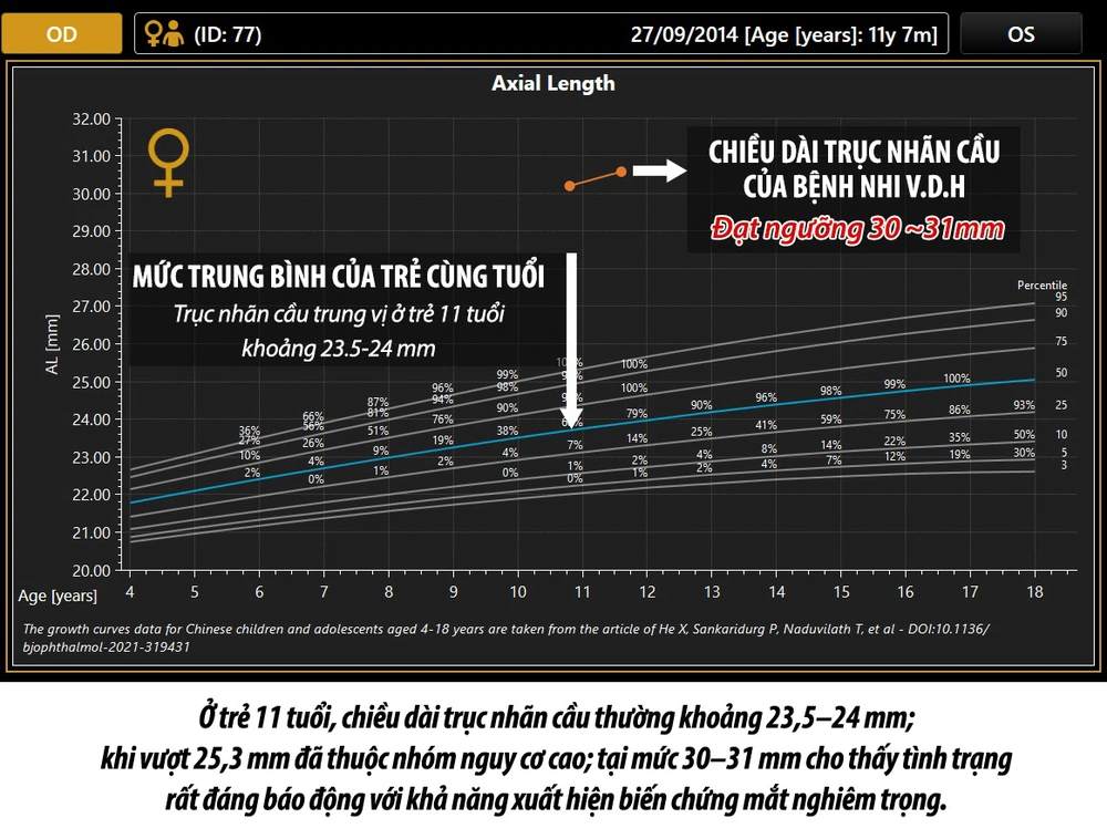 🚨 BÉ 11 TUỔI CẬN ĐẾN 14 ĐỘ – CẢNH BÁO NGUY CƠ BIẾN CHỨNG VÕNG MẠC DO CẬN THỊ TIẾN TRIỂN